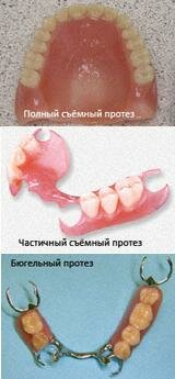 зубные протезы